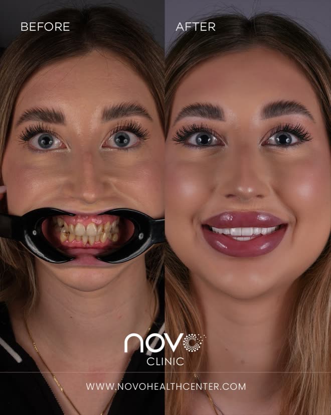 Veneers — vorher und nachher