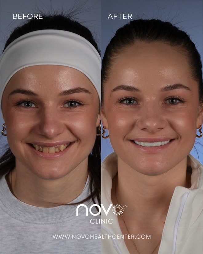 Lächeln-Makeover — vorher und nachher